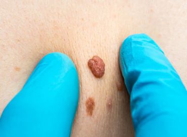 Anal Skin Tag Removal