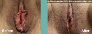 Labiaplasty Before & After